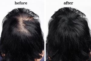 female hair loss treatment - SMP® SCALP MICROPIGMENTATION