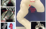 兰大二院应用3D打印辅助“体外开窗”技术全腔内治疗罕见胸主动脉畸形并主动脉夹层