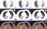 兰大二院核医学科开展肺灌注SPECT-CT断层融合显像