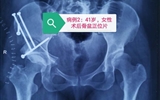 兰大二院骨科在我省首次自主完成髋臼周围截骨术（PAO）