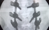 兰大二院骨科三病区完成单一小切口可扩张通道辅助下经腰椎肌间隙（Wiltse）入路腰椎融合术