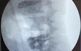 兰大二院骨科成功应用微波消融联合椎体成形技术治疗脊柱转移瘤
