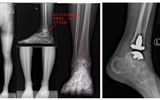立博欧赔指数第二医院骨科完成甘肃省首例INBONEII全踝关节置换手术