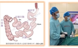 兰大二院成功开展首例单孔腹腔镜袖状胃切除术+近端空肠旷置术 微创破解重度肥胖及代谢难题