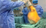 兰大二院骨科成功完成右侧大腿巨大脂肪肉瘤切除高难度手术